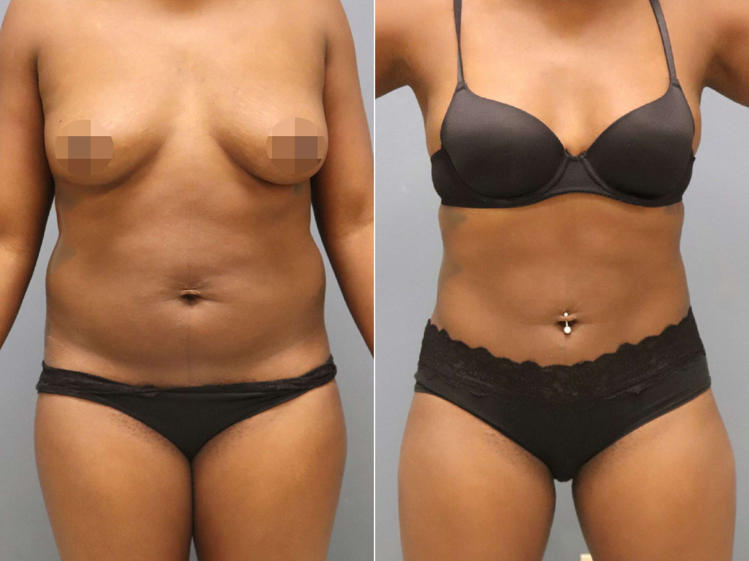 how much is liposuction