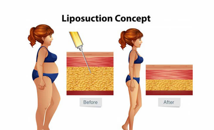 how much does liposuction cost