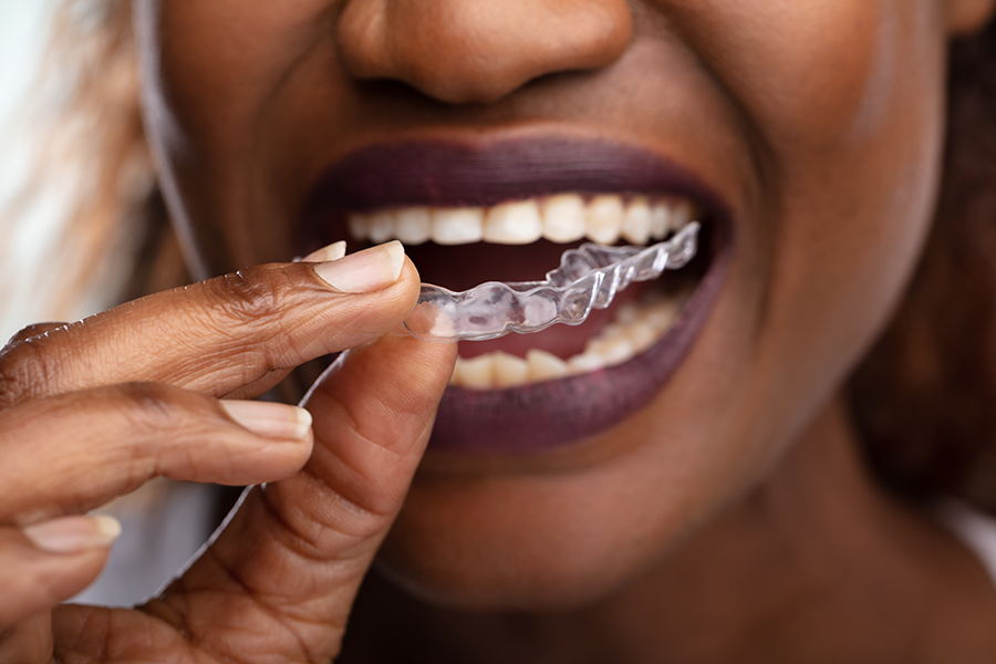 How Much Does Invasalign Cost? 1 how much does invisalign cost