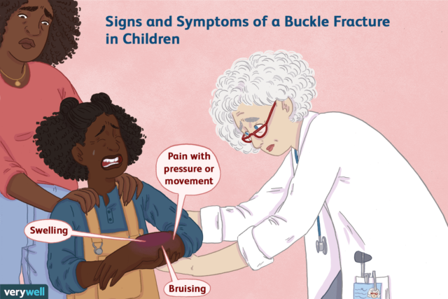 Complete information on buckle fracture with common terms