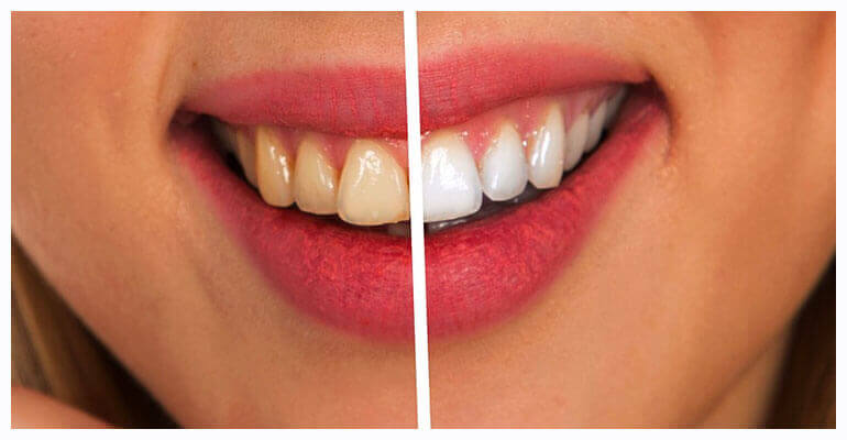 uSmile Pro Review 2022 - Best Whitening Teeth Gadget. 2 uSmile Pro Review