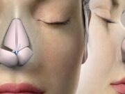 Rhinoplasty surgery: Cost, recovery, and destination Rhinoplasty surgery: Cost, recovery, and destination